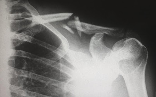 Workman’s Comp Settlement for Shoulder Injury will need to evaluate xrays.