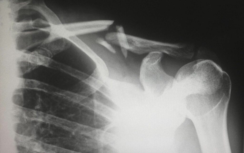 X-Ray of Broken Shoulder