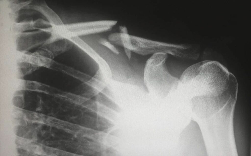 Xray of broken shoulder