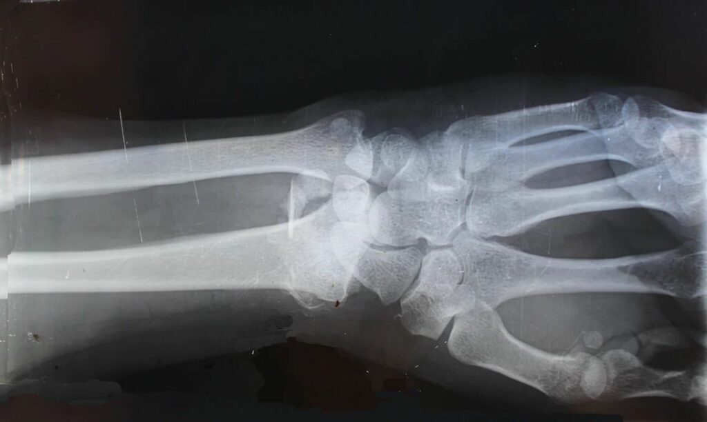 An X-ray of someone’s wrist. 
